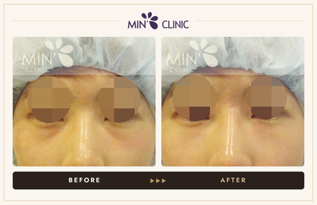Nose filler before and after, case UE-001 – MIN Clinic Seoul