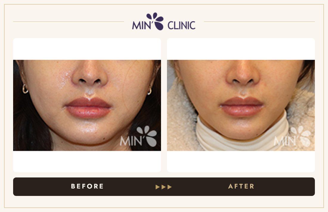 V-line Quick Slim + Jaw Botox before and after, case 9 – MIN Clinic Seoul