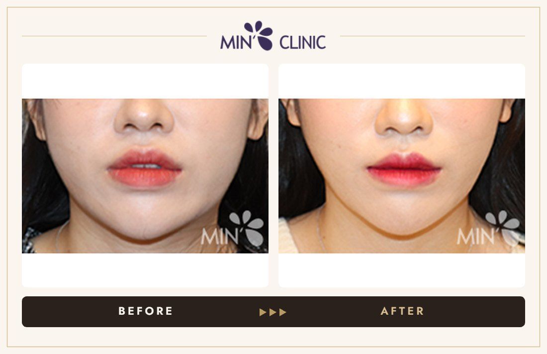 V-line Quick Slim + Jaw Botox before and after, case 10 – MIN Clinic Seoul