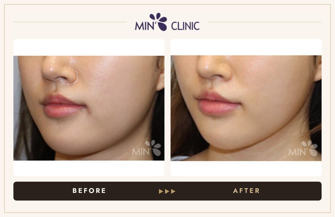 V-line Quick Slim before and after, case 13 – MIN Clinic Seoul