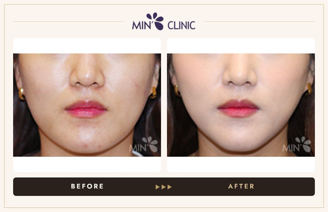 V-line Quick Slim + Jaw Botox before and after, case 11 – MIN Clinic Seoul