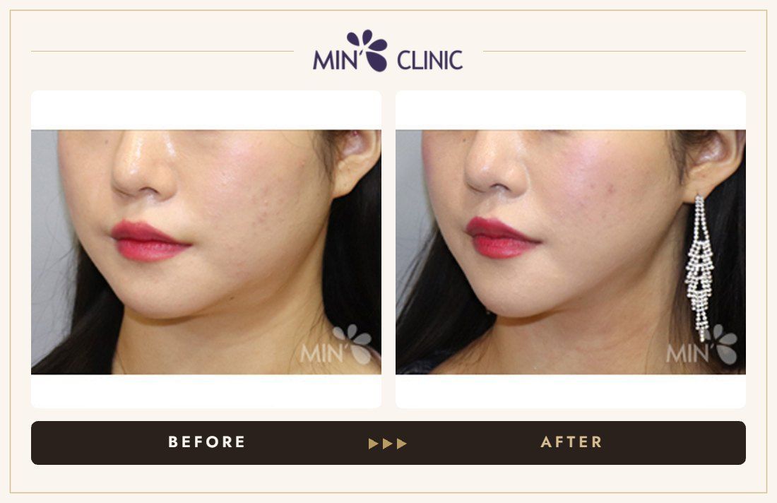 V-line Quick Slim before and after, case 14 – MIN Clinic Seoul