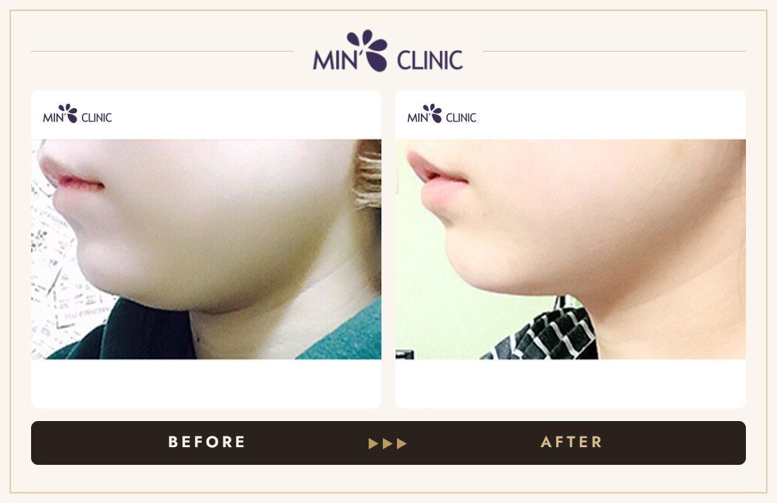 V-line Quick Slim before and after, case 15 – MIN Clinic Seoul