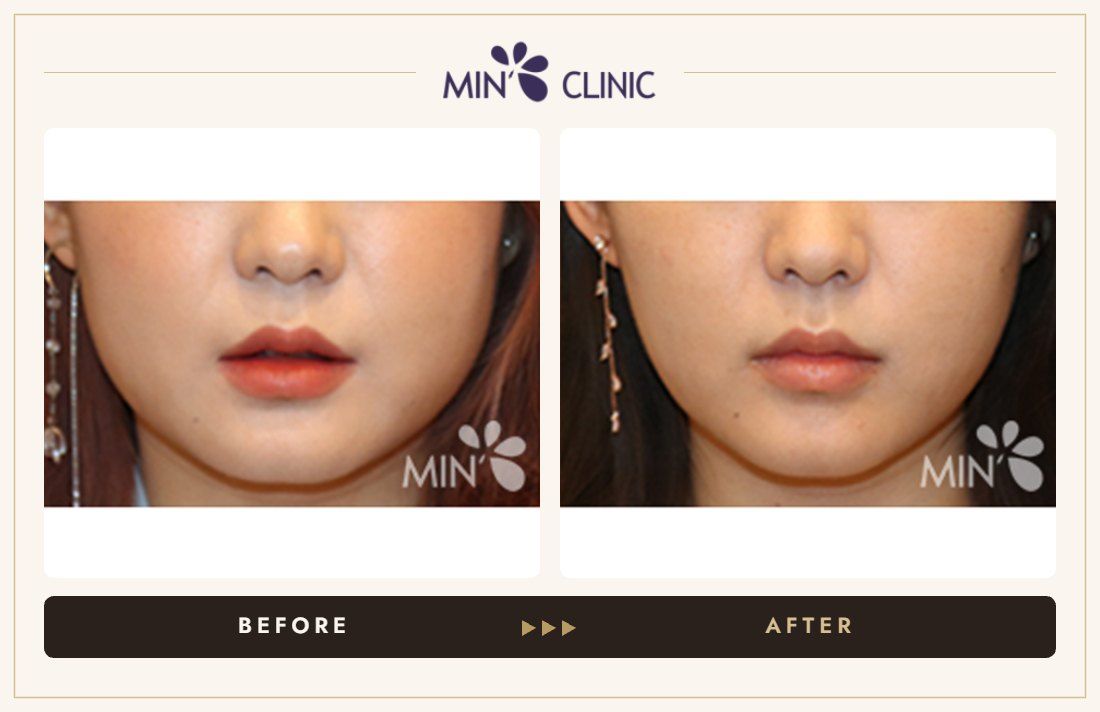 V-line Quick Slim before and after, case 16 – MIN Clinic Seoul