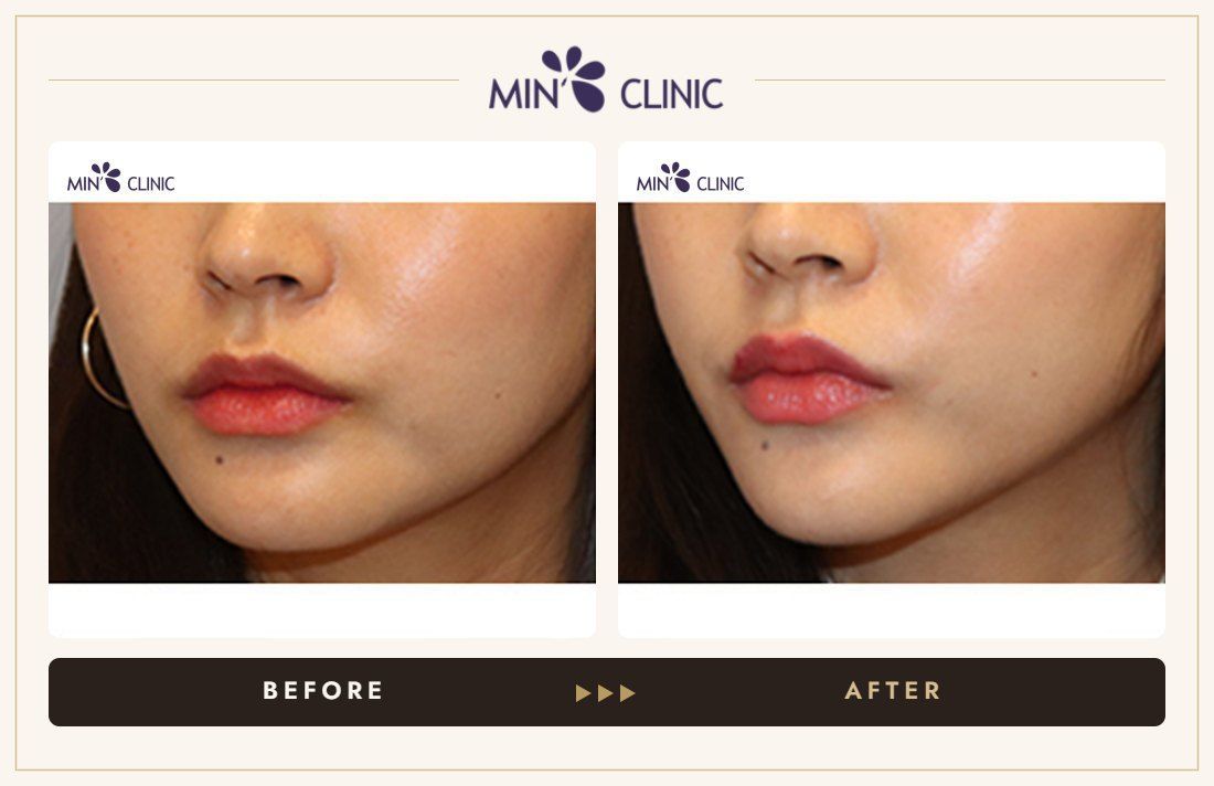 V-line Quick Slim before and after, case 17 – MIN Clinic Seoul
