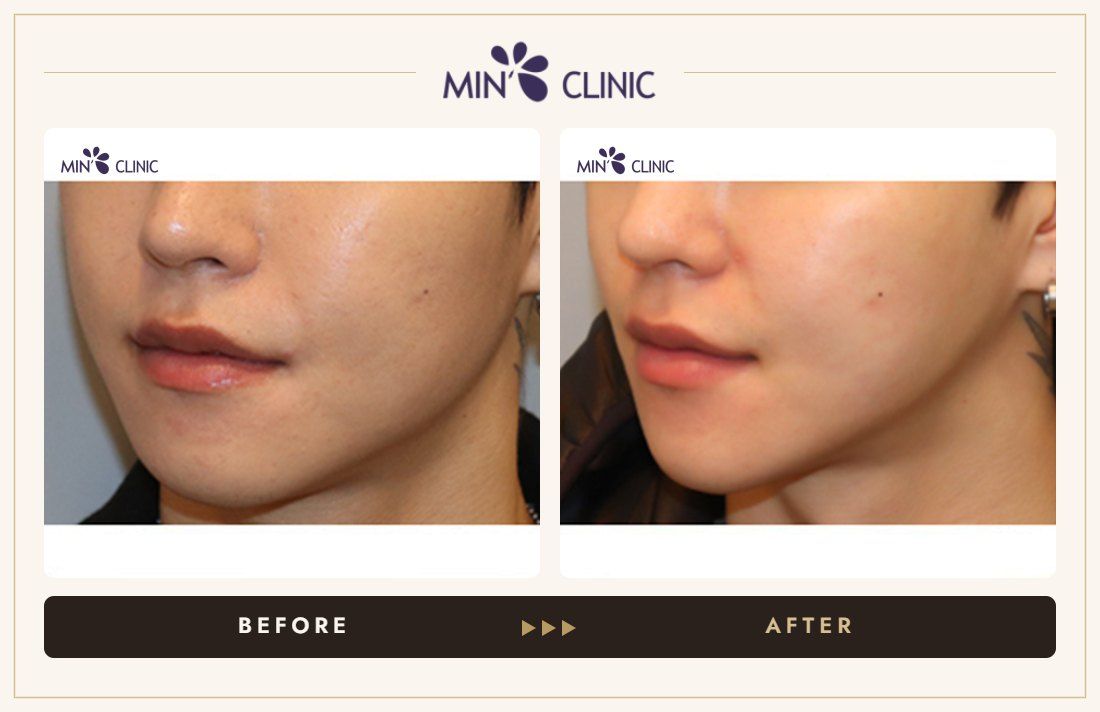 V-line Quick Slim before and after, case 18 – MIN Clinic Seoul