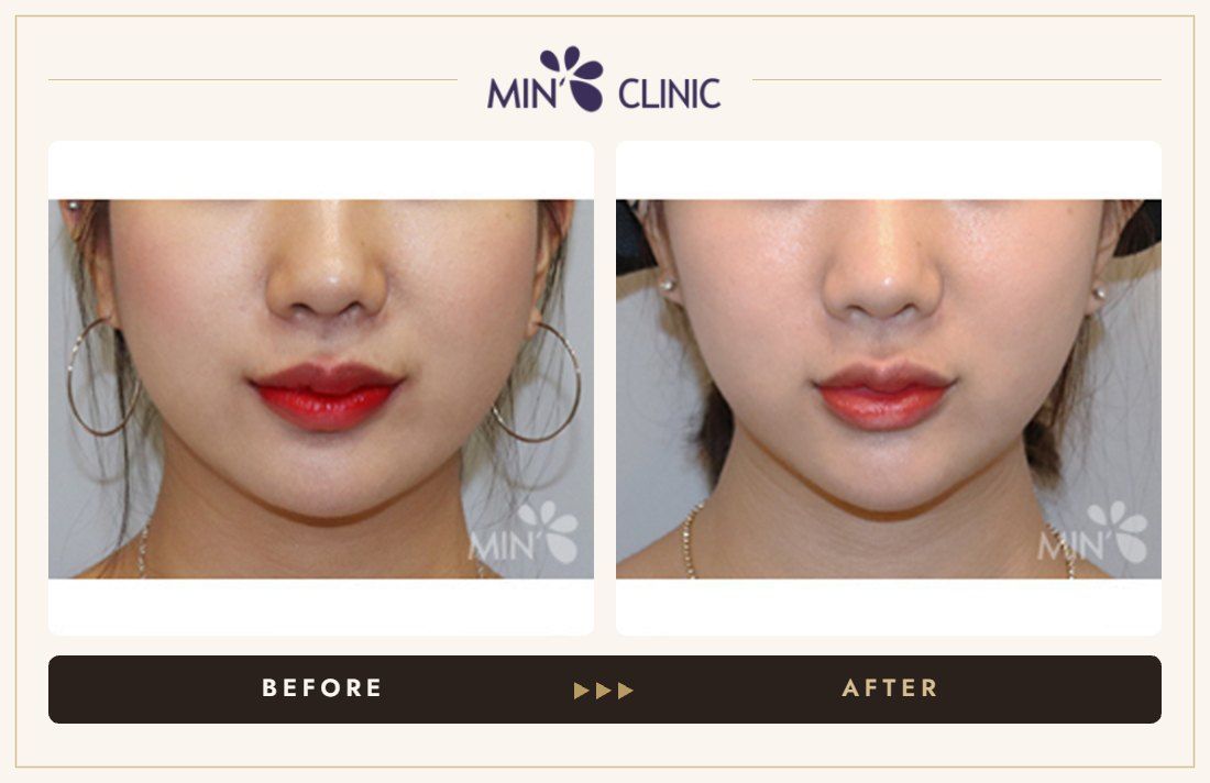 V-line Quick Slim before and after, case 19 – MIN Clinic Seoul