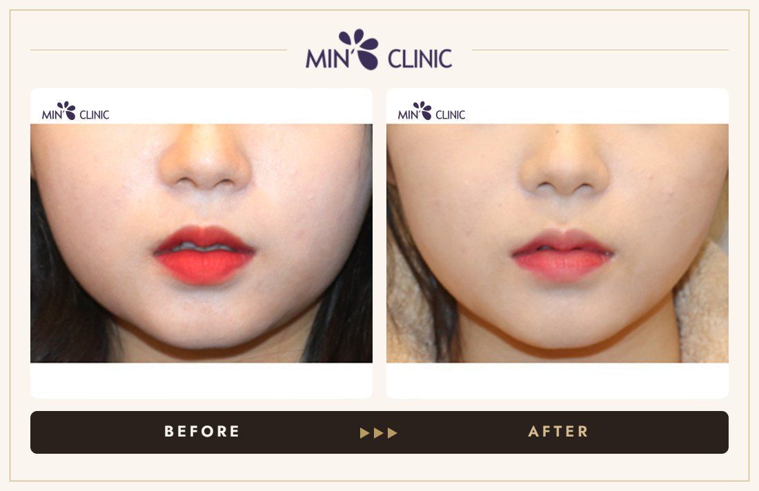 V-line Quick Slim before and after, case 20 – MIN Clinic Seoul