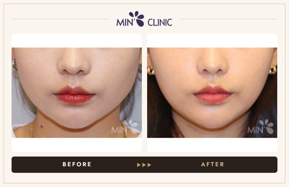 V-line Quick Slim + Jaw Botox before and after, case 12 – MIN Clinic Seoul