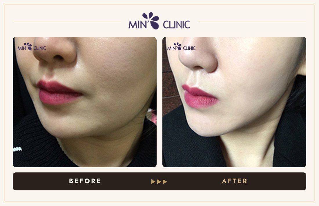 V-line Quick Slim + Jaw Botox before and after, case 13 – MIN Clinic Seoul