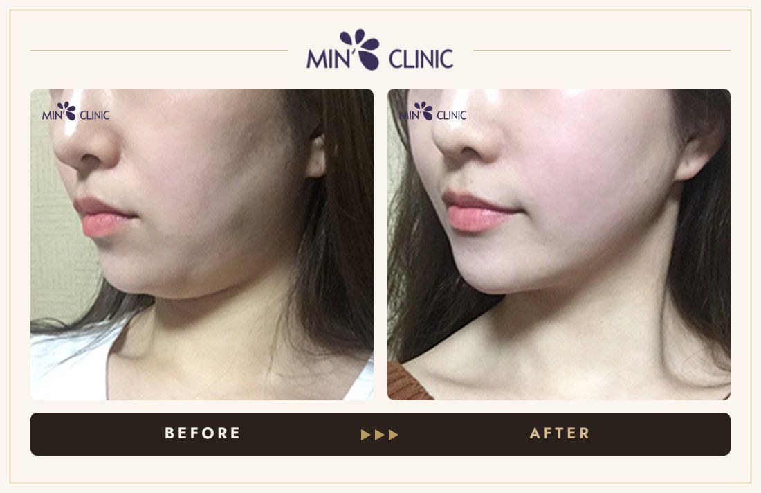V-line Quick Slim before and after, case 21 – MIN Clinic Seoul