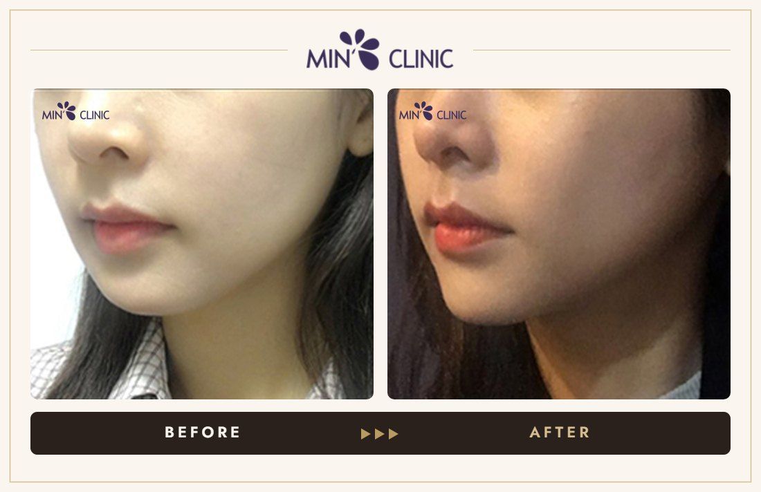V-line Quick Slim before and after, case 22 – MIN Clinic Seoul