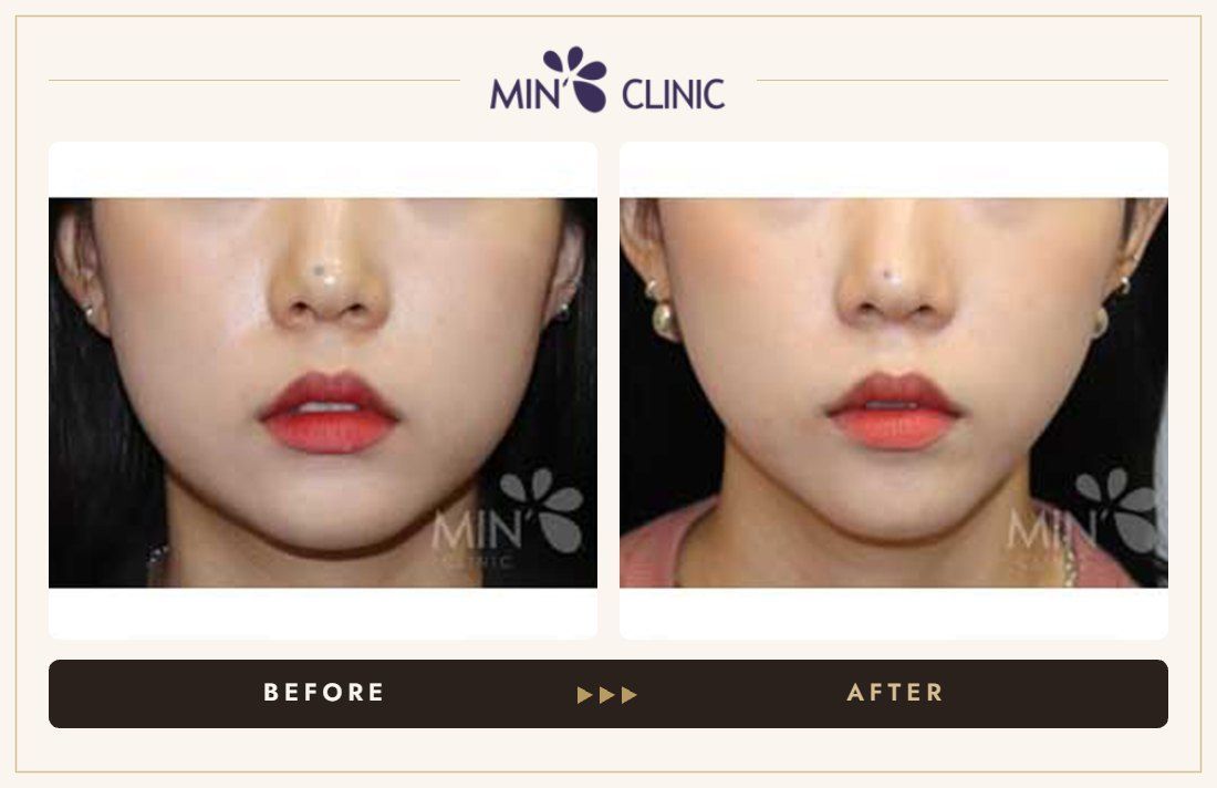 V-line Quick Slim before and after, case 23 – MIN Clinic Seoul