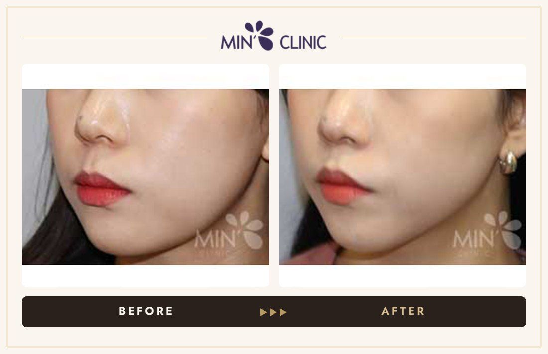 V-line Quick Slim before and after, case 24 – MIN Clinic Seoul
