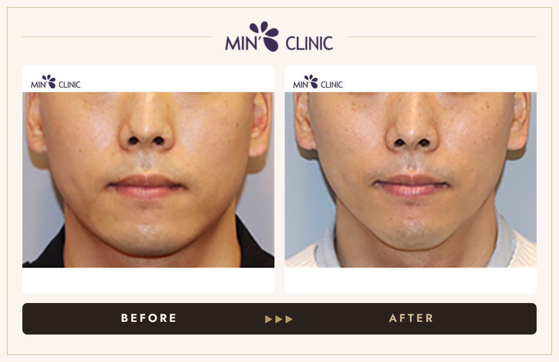 V-line Quick Slim before and after, case 25 – MIN Clinic Seoul