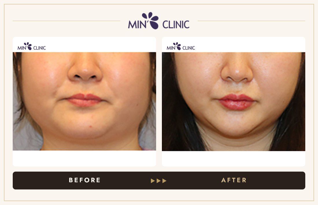 V-line Quick Slim before and after, case 26 – MIN Clinic Seoul