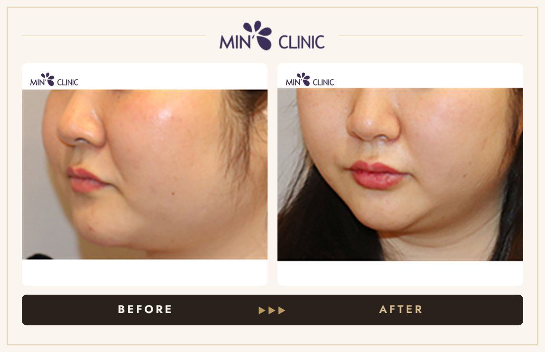 V-line Quick Slim before and after, case 27 – MIN Clinic Seoul
