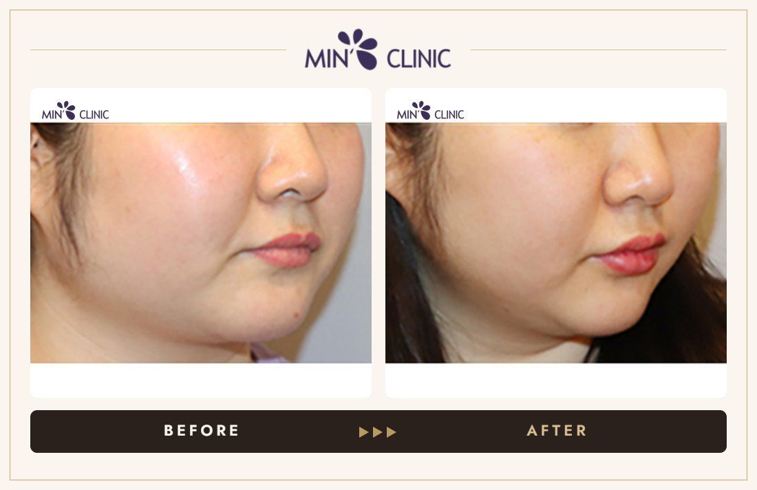 V-line Quick Slim before and after, case 28 – MIN Clinic Seoul