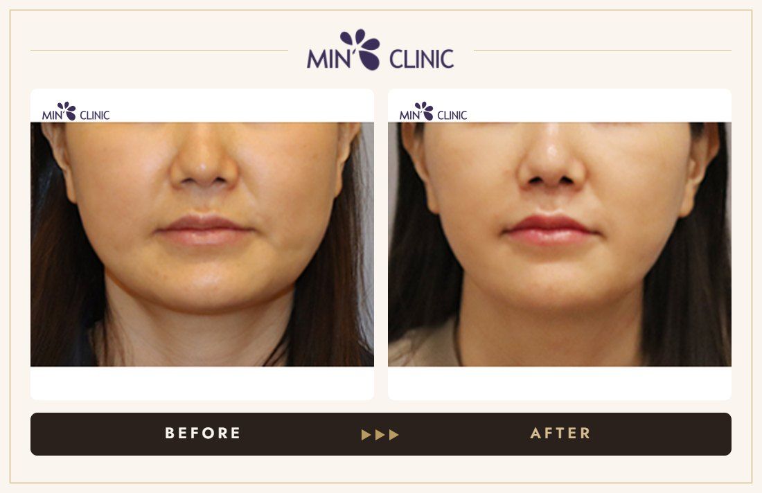 V-line Quick Slim before and after, case 29 – MIN Clinic Seoul