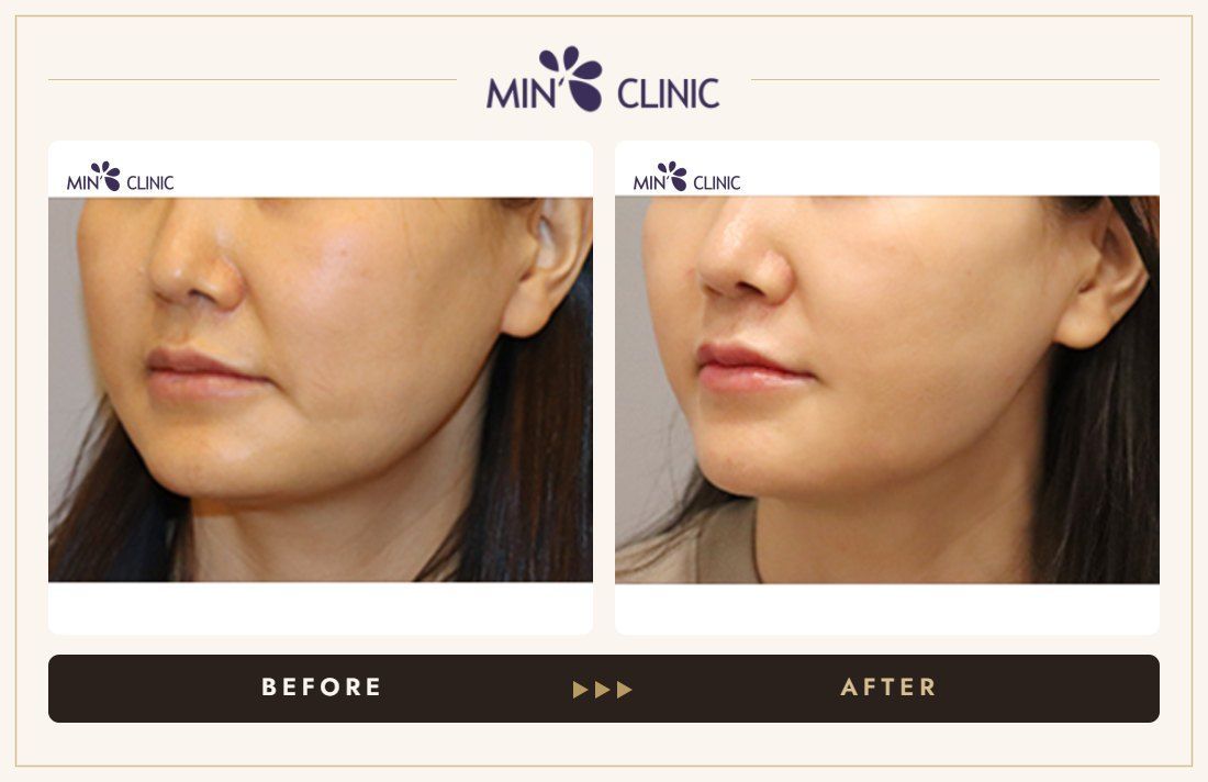 V-line Quick Slim before and after, case 30 – MIN Clinic Seoul