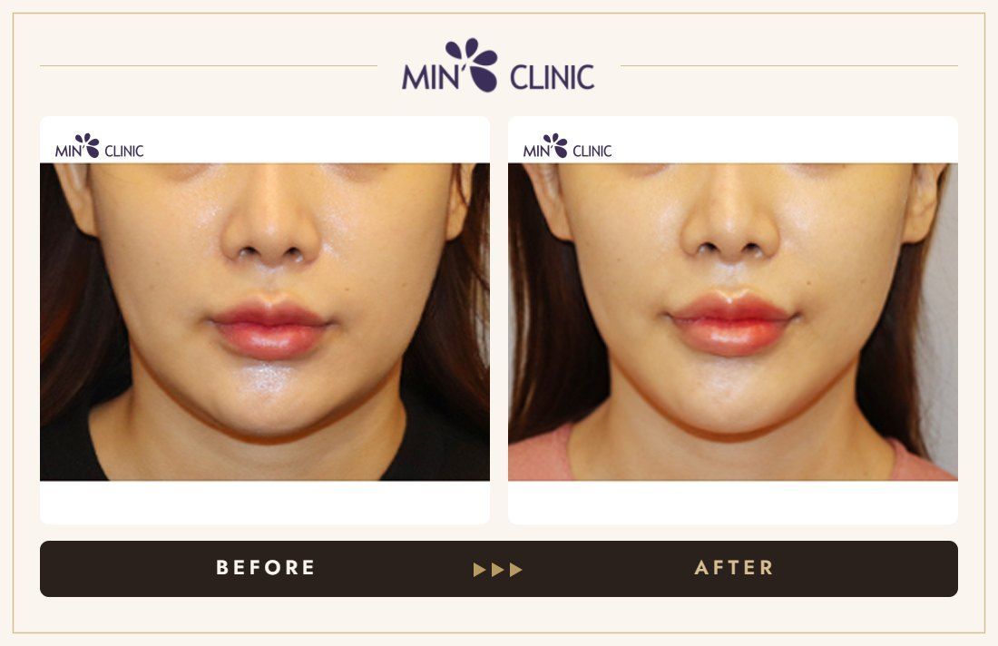 V-line Quick Slim before and after, case 31 – MIN Clinic Seoul