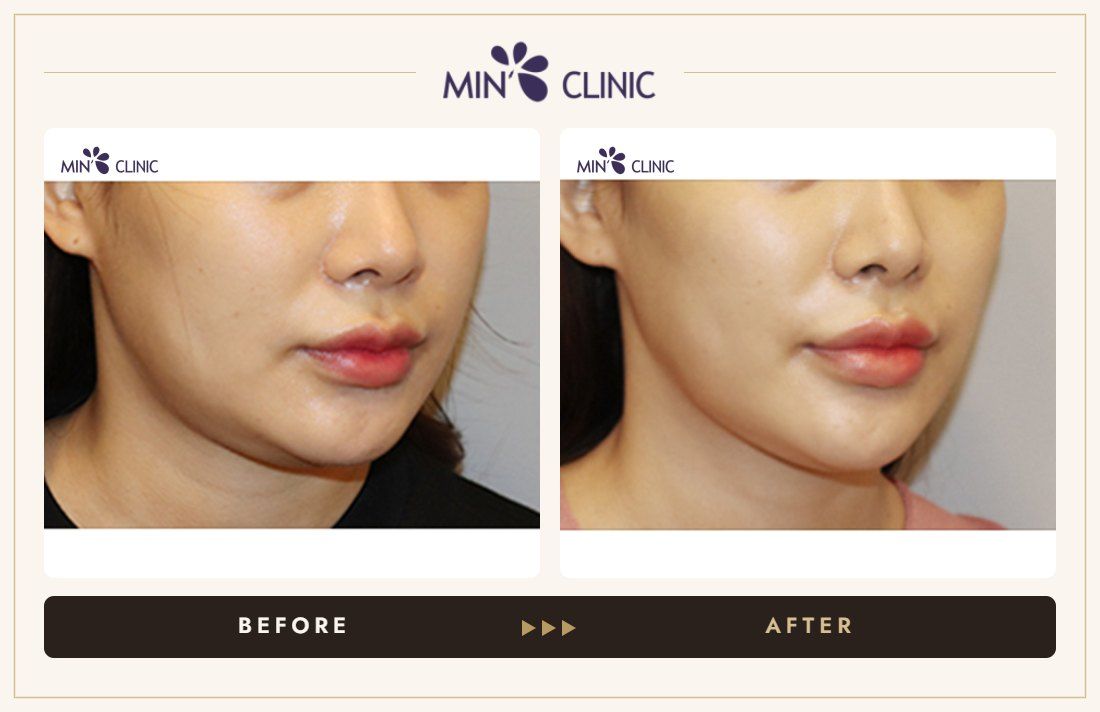 V-line Quick Slim before and after, case 32 – MIN Clinic Seoul