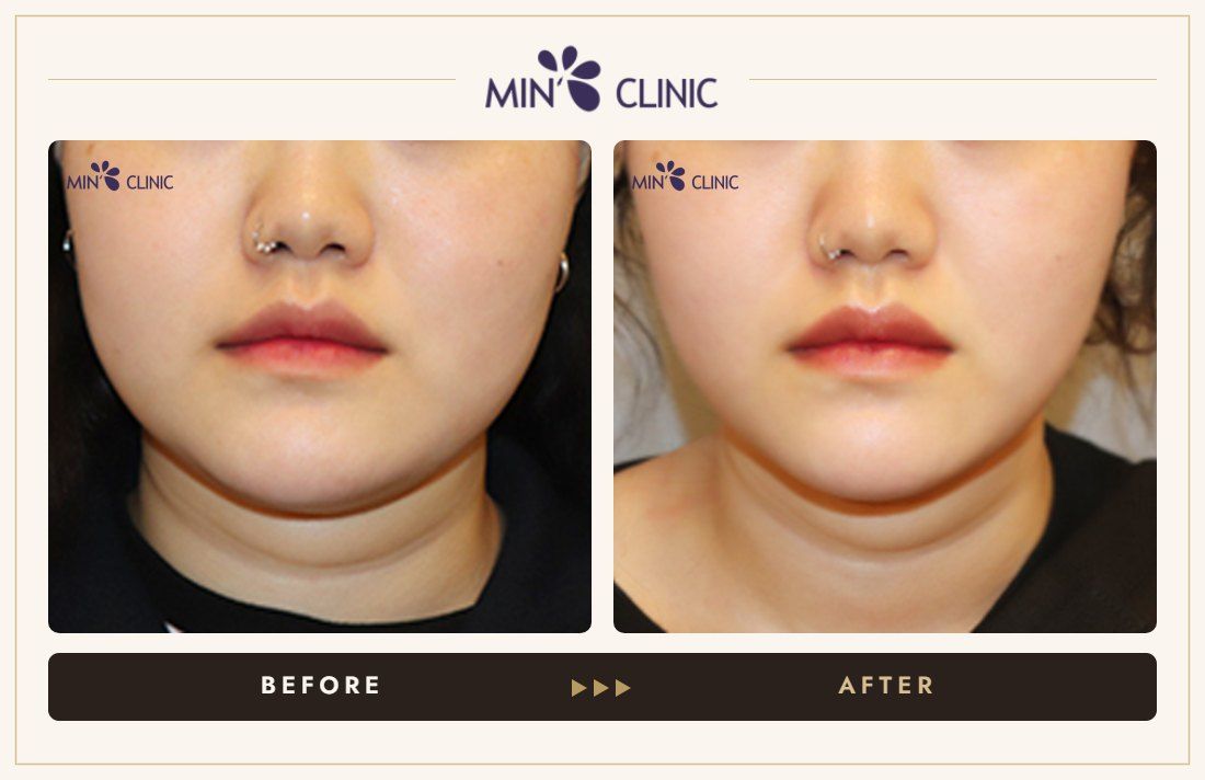 V-line Quick Slim before and after, case 33 – MIN Clinic Seoul