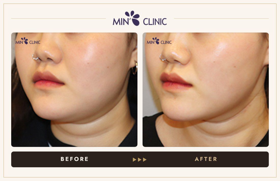 V-line Quick Slim before and after, case 34 – MIN Clinic Seoul