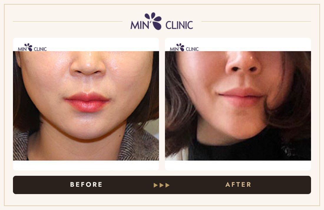 V-line Quick Slim + Jaw Botox before and after, case 14 – MIN Clinic Seoul