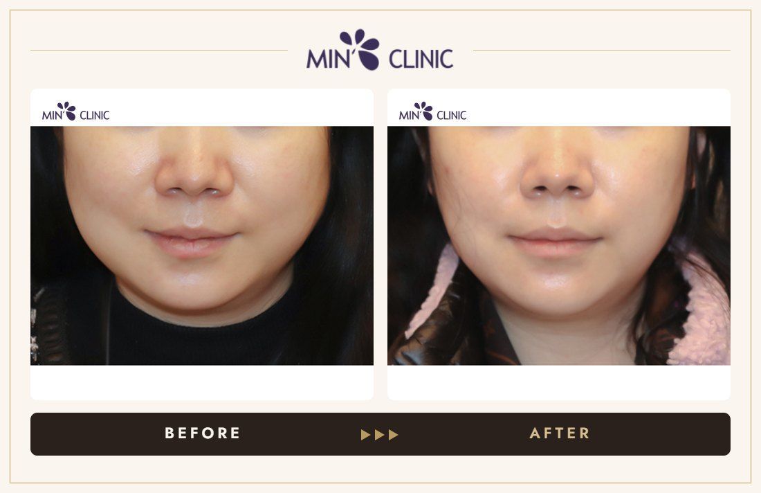 V-line Quick Slim before and after, case 35 – MIN Clinic Seoul