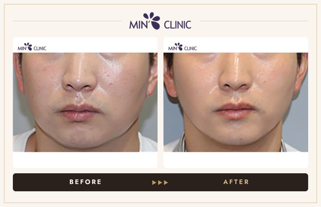 V-line Quick Slim before and after, case 36 – MIN Clinic Seoul