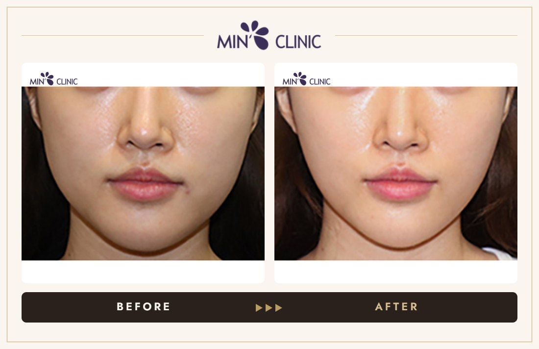 V-line Quick Slim before and after, case 37 – MIN Clinic Seoul
