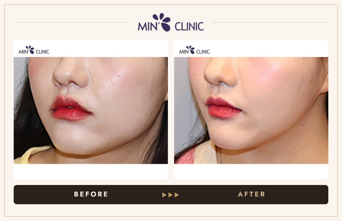 V-line Quick Slim + Jaw Botox before and after, case 15 – MIN Clinic Seoul