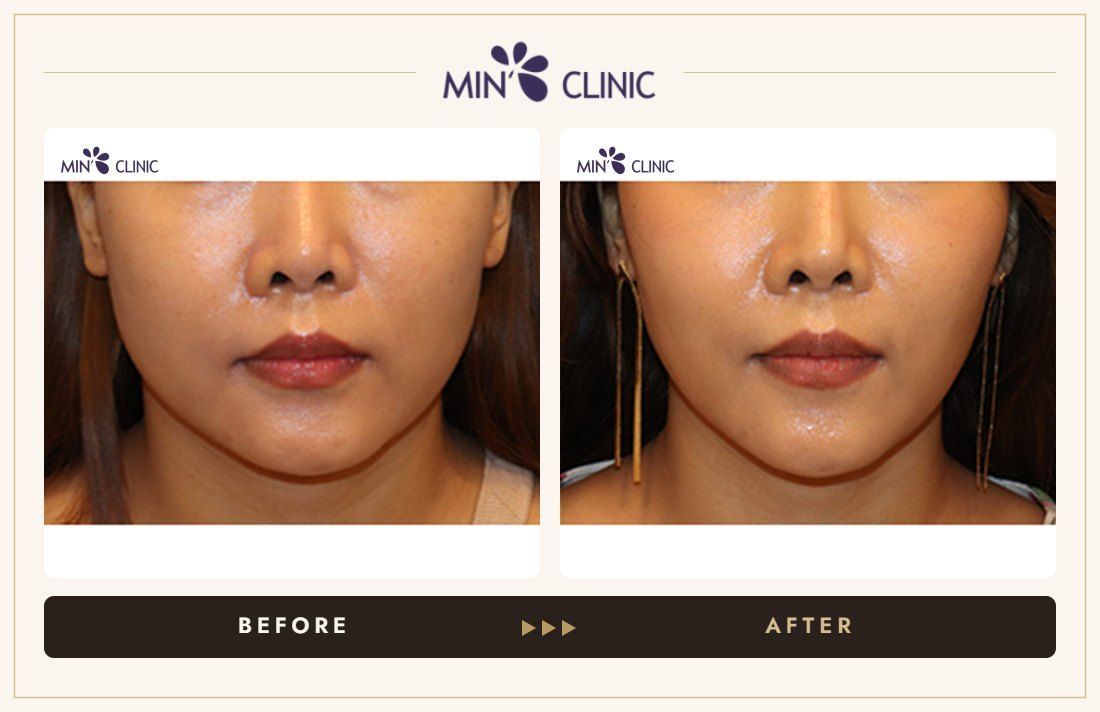 V-line Quick Slim before and after, case 38 – MIN Clinic Seoul