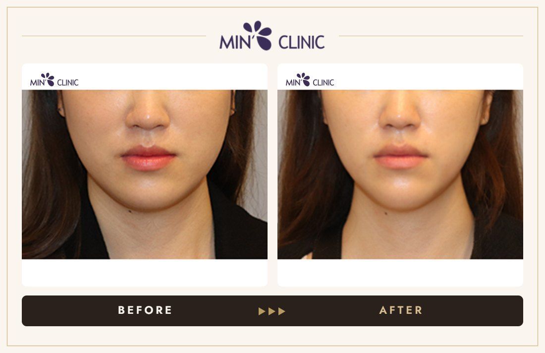 V-line Quick Slim before and after, case 39 – MIN Clinic Seoul