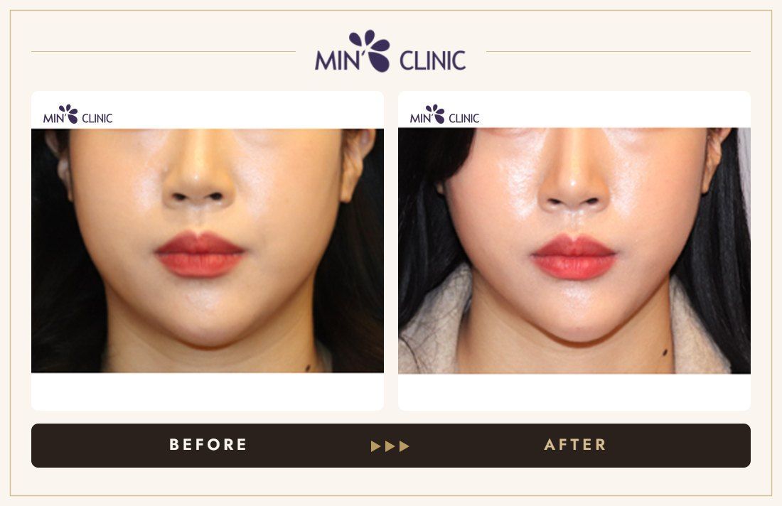 V-line Quick Slim before and after, case 40 – MIN Clinic Seoul