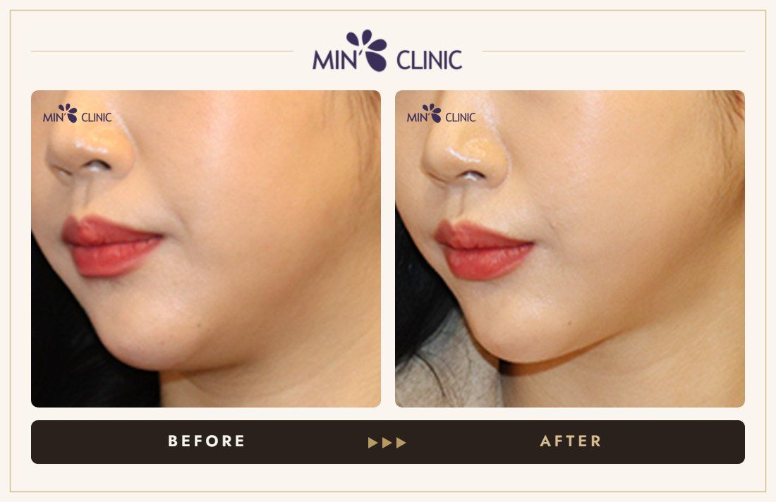 V-line Quick Slim before and after, case 41 – MIN Clinic Seoul