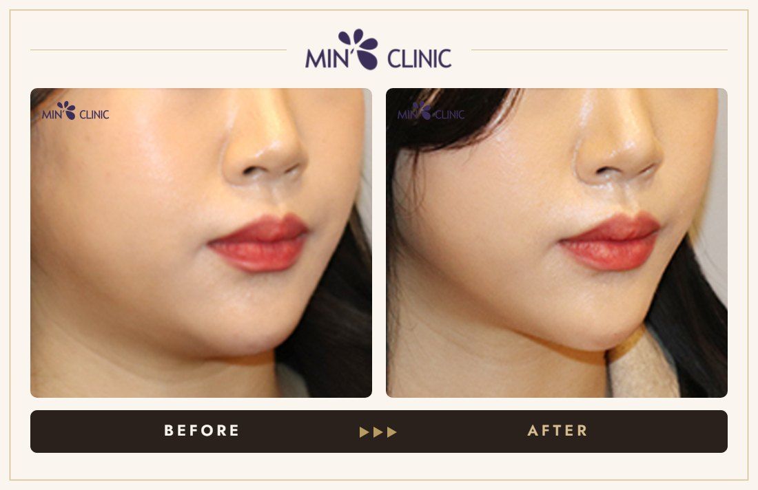 V-line Quick Slim before and after, case 42 – MIN Clinic Seoul