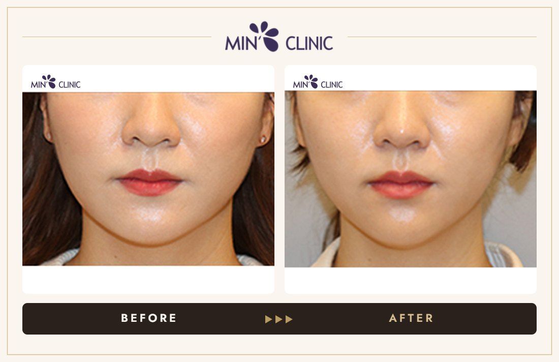 V-line Quick Slim before and after, case 43 – MIN Clinic Seoul