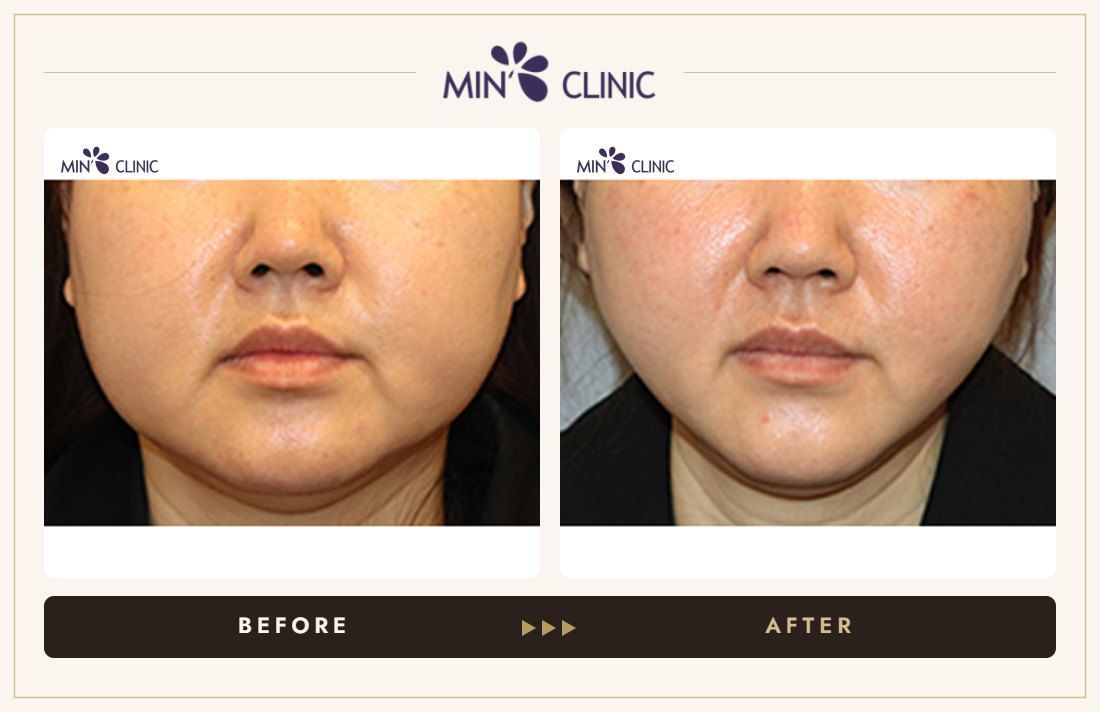 V-line Quick Slim before and after, case 44 – MIN Clinic Seoul