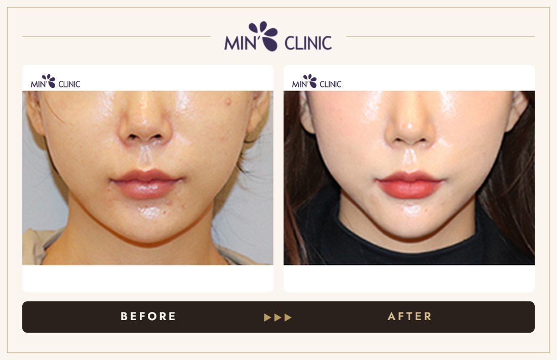 V-line Quick Slim before and after, case 45 – MIN Clinic Seoul