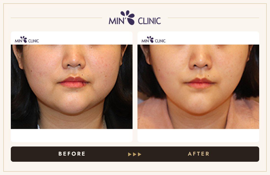 V-line Quick Slim before and after, case 46 – MIN Clinic Seoul