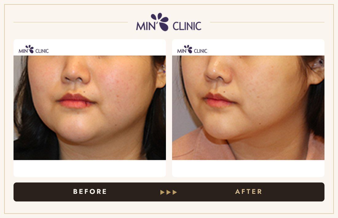 V-line Quick Slim before and after, case 47 – MIN Clinic Seoul