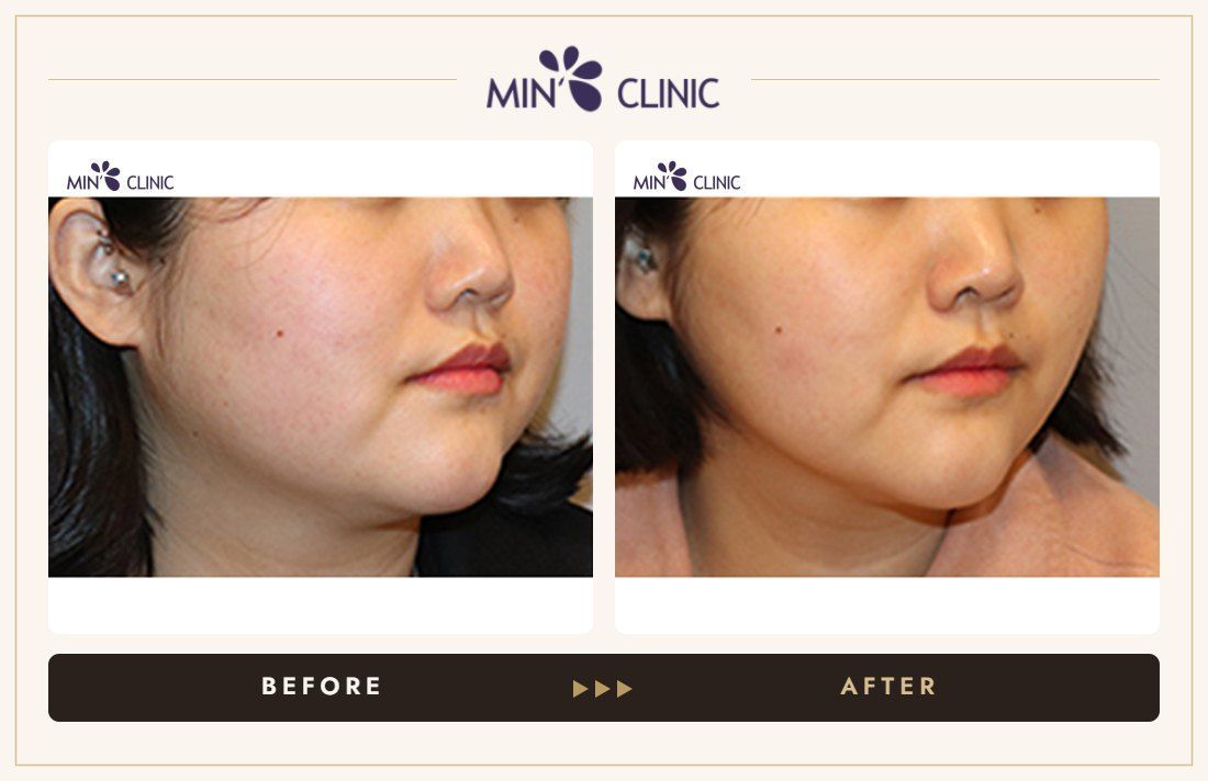V-line Quick Slim before and after, case 48 – MIN Clinic Seoul
