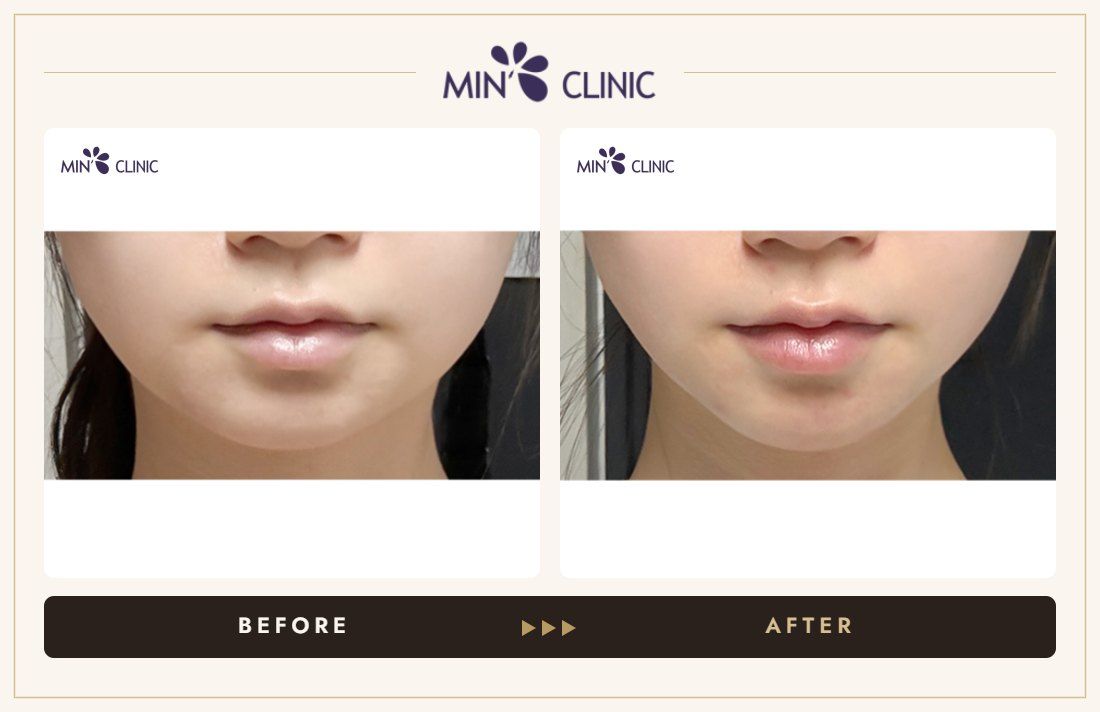 V-line Quick Slim before and after, case 49 – MIN Clinic Seoul