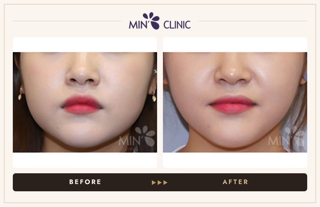 V-line Quick Slim + Jaw Botox before and after, case 16 – MIN Clinic Seoul