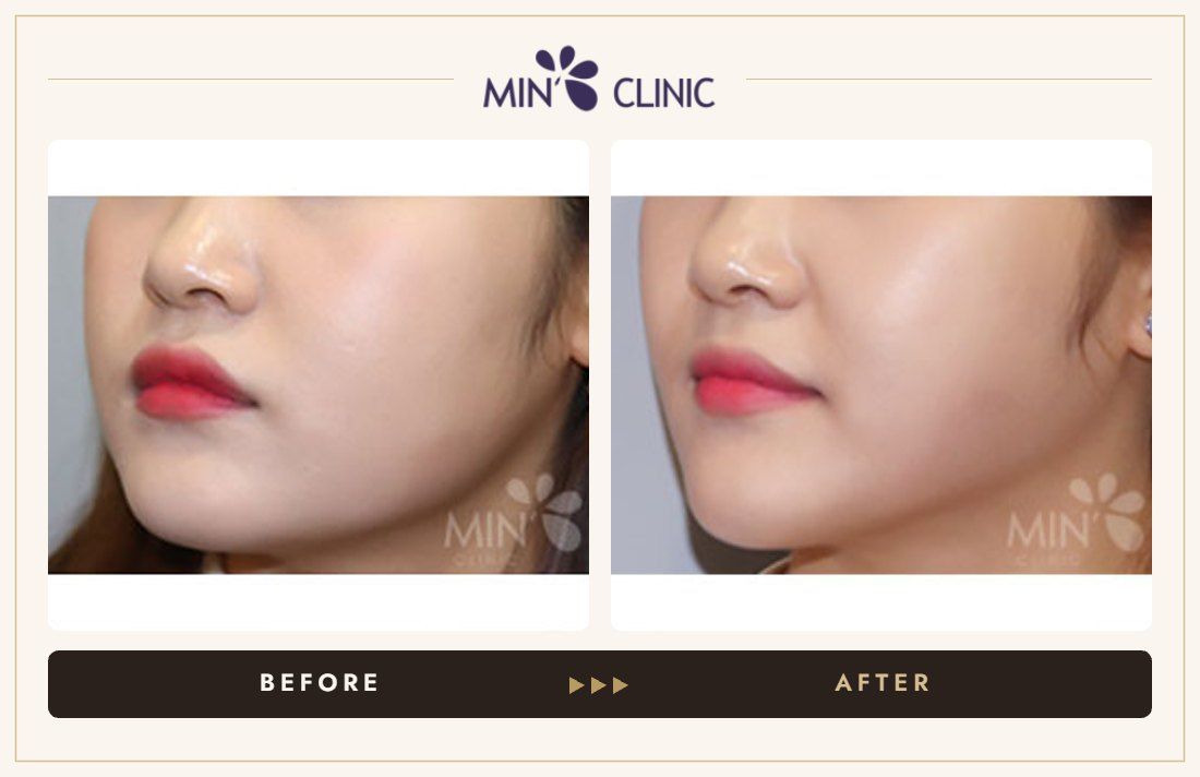V-line Quick Slim + Jaw Botox before and after, case 17 – MIN Clinic Seoul