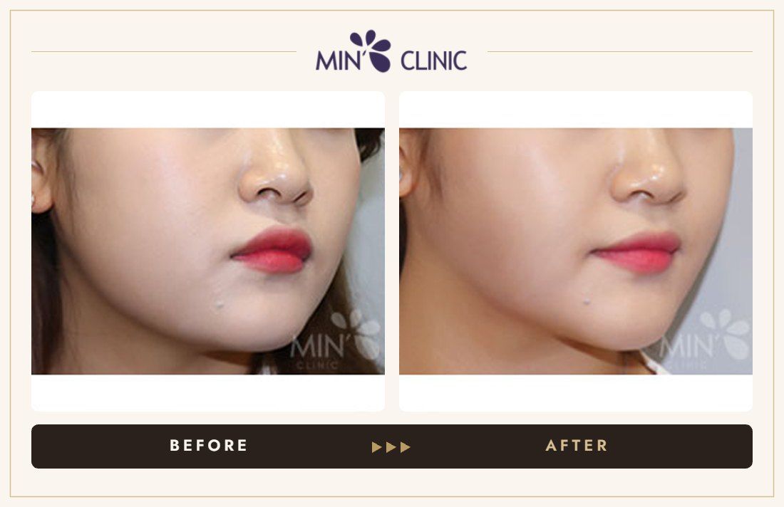 V-line Quick Slim + Jaw Botox before and after, case 18 – MIN Clinic Seoul