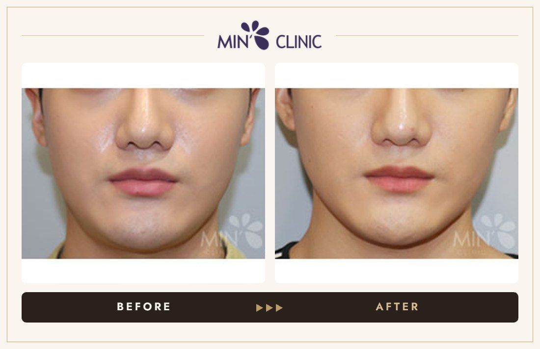 V-line Quick Slim before and after, case 50 – MIN Clinic Seoul