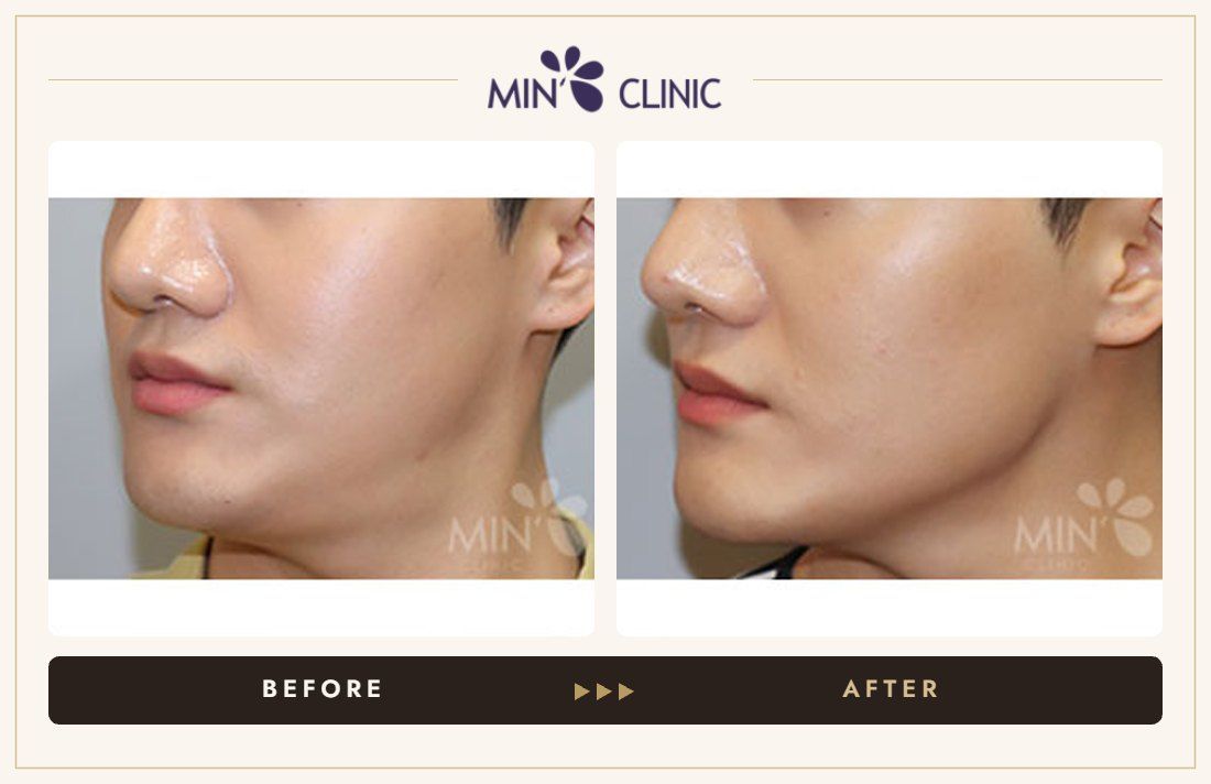 V-line Quick Slim before and after, case 51 – MIN Clinic Seoul